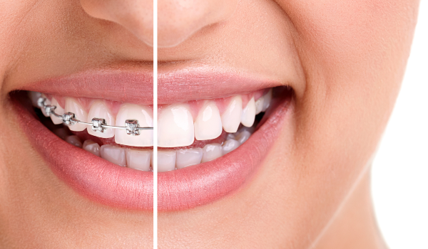 How do braces work?